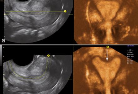 Preliminary experience with Advanced Volume Contrast Imaging (VCI) and Omniview in obstetric and gynecologic ultrasound